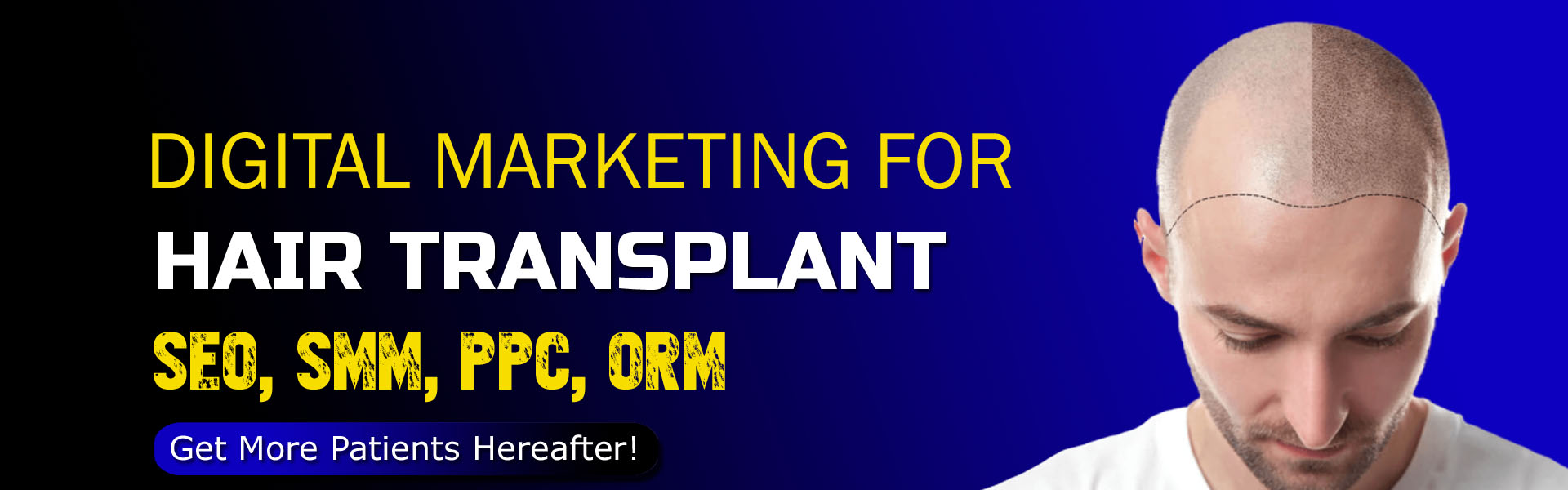 hair transplant seo smo ppc digital marketing